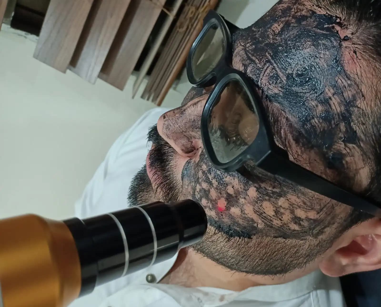 Carbon Laser Facial